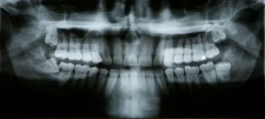 Panoramic dental X-ray image reviewed at Valdosta GA dental practice.