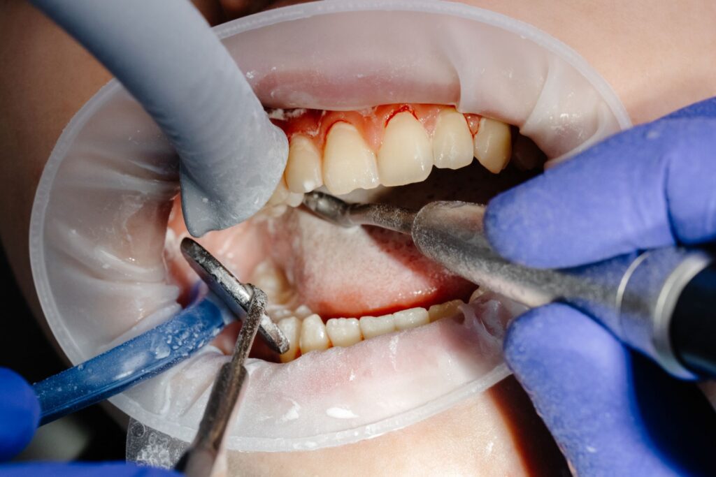 Dental filling procedure at dental office in Valdosta GA.